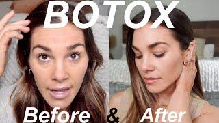 MY BOTOX EXPERIENCE | Before & After | Pricing, Units, Results