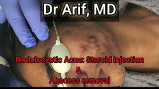 Nodulocystic acne: Injection & Abscess removal @DrArifMDDermatologist  #acnetreatment  #acne #dermatology