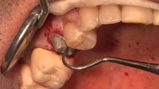Permanent cementation of a crown using Totalcem