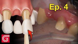 HOW TO Try-In ZIrconia Crowns BEFORE Cementation | Ep 4