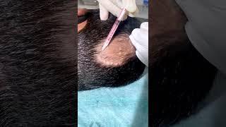 Alopecia Areata Treatment For Hair Growth | Treatment Of Alopecia | Skinaa Clinic #shorts #viral