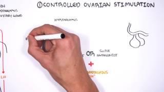 In Vitro Fertilization (IVF) - Overview