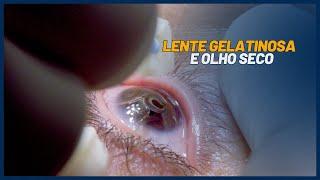 Olho Seco e Lentes Gelatinosas: Como Manter a Saúde Ocular em Tempos Secos