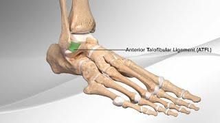 Chronic Ankle Sprain Repair With the InternalBrace™ Ligament Augmentation Procedure