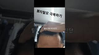 초기 M자탈모 극복