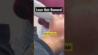 Laser Hair Removal face| Laser for hair removal| Laser hair reduction in Delhi