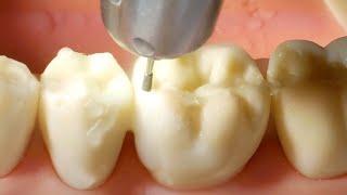 Composite Preparation Walkthrough for #19 MO Approximal Box and Occlusal Fill