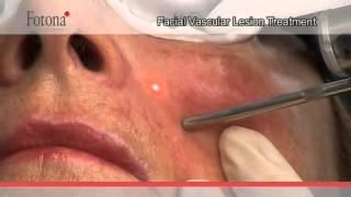 Facial Vein Removal with Fotona Laser @ rtwskin