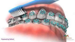 Life with Braces - Brushing & Flossing