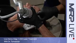 MRP Live Demo: Edge 1 CO2 Laser Treatment With Dr. Tomassian