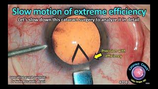 CataractCoach™ 2081: slow motion of extreme efficiency