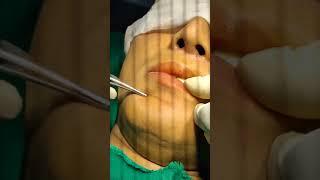 Chin Ptosis Surgery Cost in India