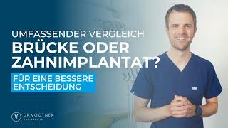 Brücke oder Zahnimplantat? Ein umfassender Vergleich für eine bessere Entscheidung!