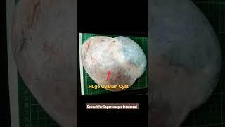 Large Ovarian Cyst #shorts #healthmedia