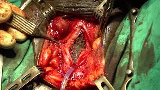 Double Penile Skin Graft Urethroplasty