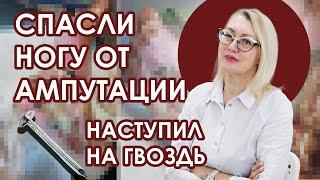 Обычный гвоздь почти довёл до ампутации. История пациента.