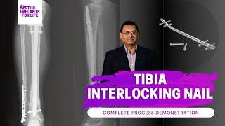 Tibia Interlocking Nail Complete Procedure