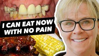 Teeth Restored with 3 on 6™ Implants and Bridges - Eat without pain!