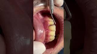 VERY BIG LESION periodontal #dentistry #periodontist #periodontaltherapy #periodontitis #dentist