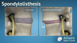 Spondylolisthesis