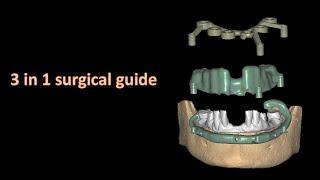 Guided full arch Implant placement 3 in 1 surgical guide