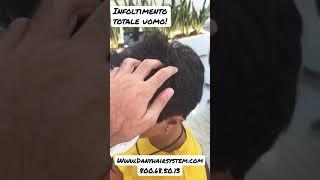 Infoltimento totale uomo per alopecia con patch cutanea o protesi capillare di ultima generazione!