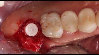 Crestal Sinus Lift with PRF and Simultaneous Zeramex XT Implant Placement