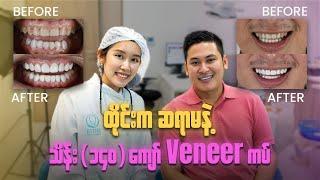 ထိုင်း ရောက်တုန်း Veneer ကပ် Vlog