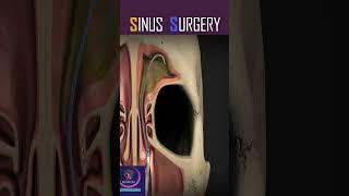 Ballon Sinuplasty, Sinus Surgery #shorts