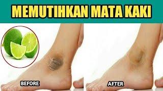 CARA MEMUTIHKAN KULIT MATA KAKI YANG HITAM