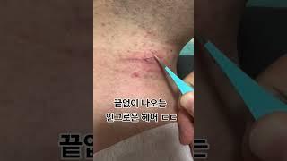 끝 없이 나오는 인그로운 헤어 ㄷㄷ..