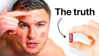 If You Have Acne, WATCH THIS Before Taking Antibiotics!