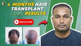 FUE Hair Transplant 4 MONTHS RESULTS | Best Hair Transplant In Guwahati