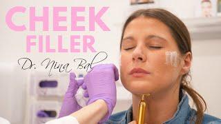 Cheek Filler Before and After | Dr. Nina Bal | London  Cheek Filler Treatment