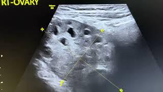 Ultrasound of right ovarian torsion.