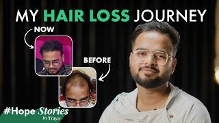 "I Stopped My Genetic Hair Loss with This Product" - Yasin Shares His Emotional Story #HopeStories