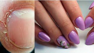 Huge Transformation On Stubby Nails / Snipping Off Cuticle With A Nail Drill 