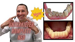 Das war besonders! Unterkiefer mit Teleskop-Brücke komplett neu  | Zahnarzt Dr. Maximilian Fuhrmann