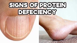 10 Sure Signs of a Protein Deficiency and What You Can Do About It