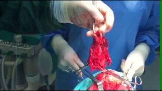 Aziz Aliyev, СОВРЕМЕННАЯ ХИРУРГИЯ ГОЛОВЫ И ШЕИ  10LarynxSurgery