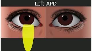 Relative Afferent Pupillary Defect - Medical Student Education