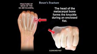 Boxer's Fracture.