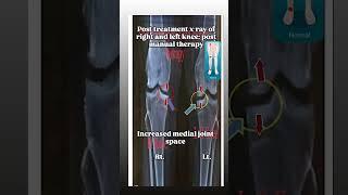 #Knee arthritis cured #manualtherapy #varusknee treatment #xray-pre n post result #kneepain #knee