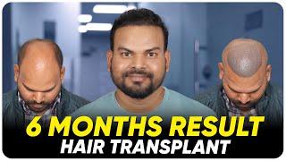 Hair Transplant in Chennai | Best Results & Cost of Hair Transplant in Chennai