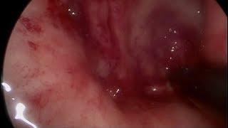 Transanal Minimally Invasive Surgery