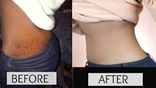 HOW TO GET RID OF STRETCH MARKS & SCARS FAST!