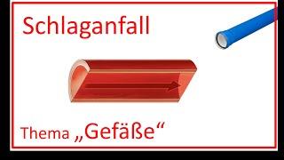 Schlaganfall Thema Gefäße