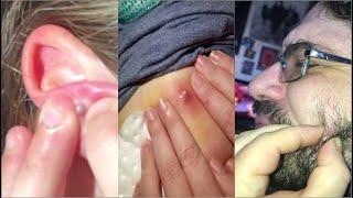 Popping Huge Blackheads and Pimple Popping - Best Pimple Popping Videos 16