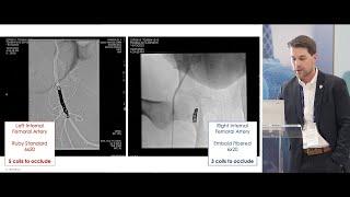 EMBOLD™ Detachable Coil System Pre-Clinical Comparative Study