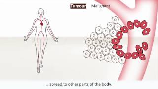 Cancer - Causes and treatment of cancer